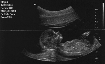 ultrasound-2007-02-29-sm.png